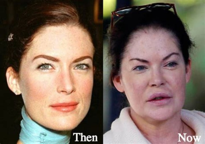 Lara Flynn Boyle Plastic Surgery Before and After